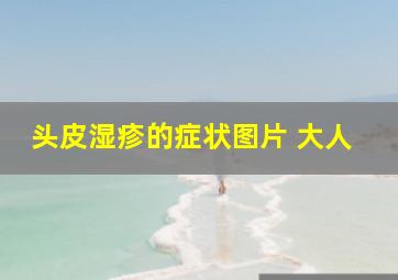 头皮湿疹的症状图片 大人